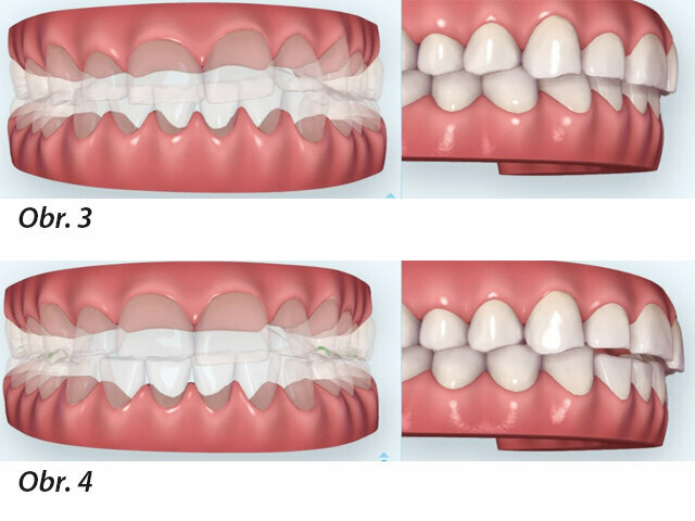 Původní klinická situace - obroušené frontální zuby a kompenzatorní extruze / Klinická situace 9 měsíců po fóliové ortodontické léčbě. Bylo dosaženo 2mm intruze.