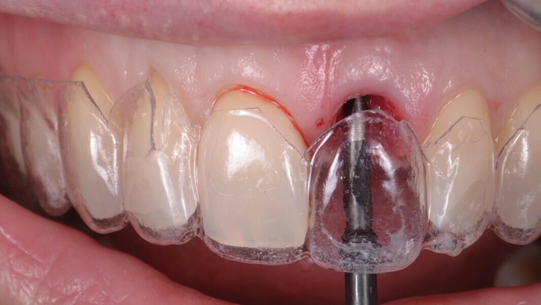 Fig. 12a : Un second guide fabriqué sur la base du wax-up diagnostique. La morphologie de la dent et le profil d’émergence ont été reproduits et servent de référence pour le positionnement de l’implant. (a et b). 