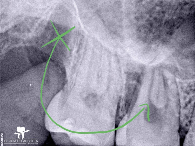 Fig. 3 : La dent 18 a été transplantée dans l’alvéole dentaire 16.