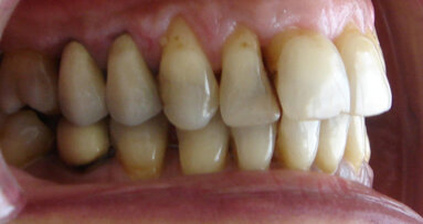 Difetti parodontali: correzioni ortodontiche e chirurgiche