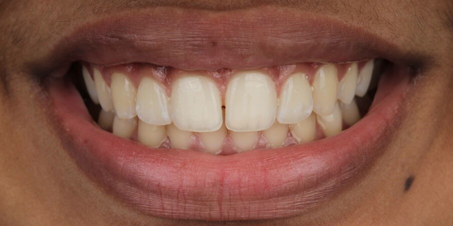 Fig 1. Initial Smile