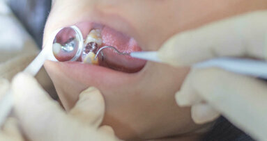 Les particules de mercure  : source importante d'exposition  dans la profession dentaire