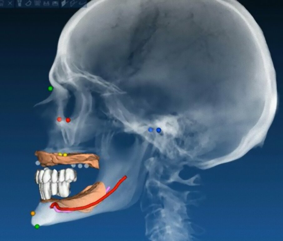 Fig. 7_Valutazione tra spina nasale anteriore e punto più sporgente della corona clinica dell’incisivo superiore.