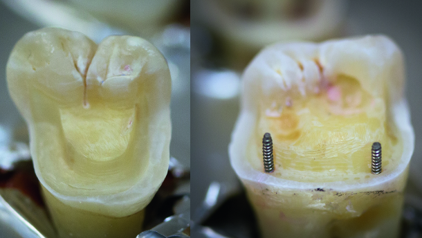 Exploring the fracture resistance of retentive pin-retained e.max press onlays in molars