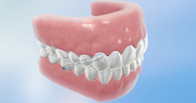 Align Technology introduces Invisalign G3