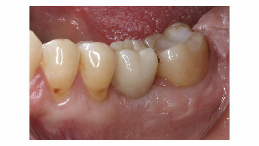 Fig. 4: Implant crown after one week of placement.