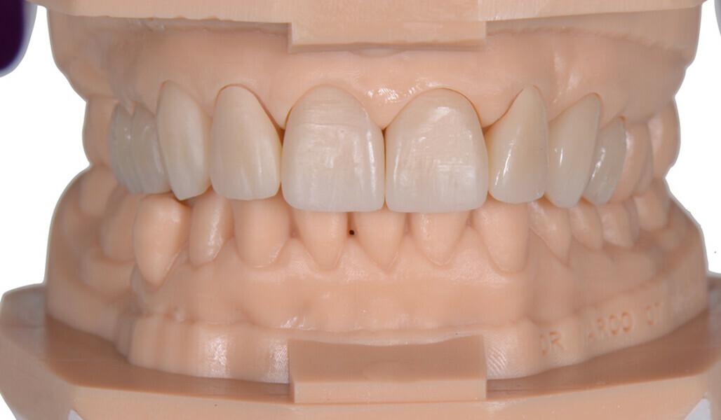 Fig. 14: Frontal view of the sintered restorations on the resin models.