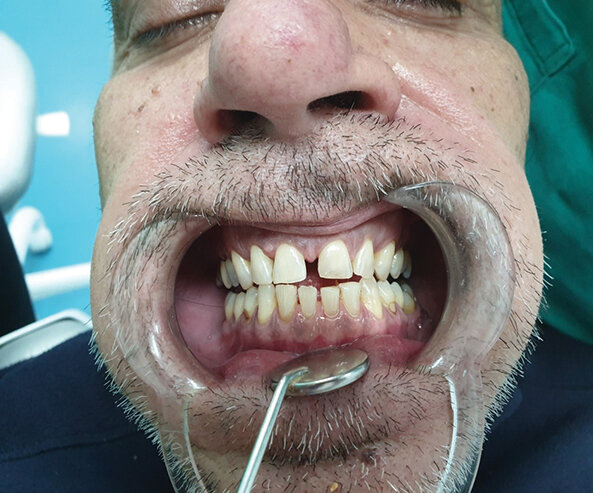Sl. 1.1: Pacijent A, pušač nakon poliranja i beljenja zuba