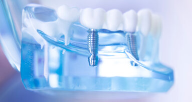 Novel technology could improve efficacy of metal-based dental implants
