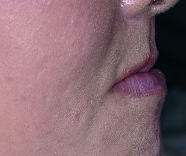 Fig 5. Concave facial profile