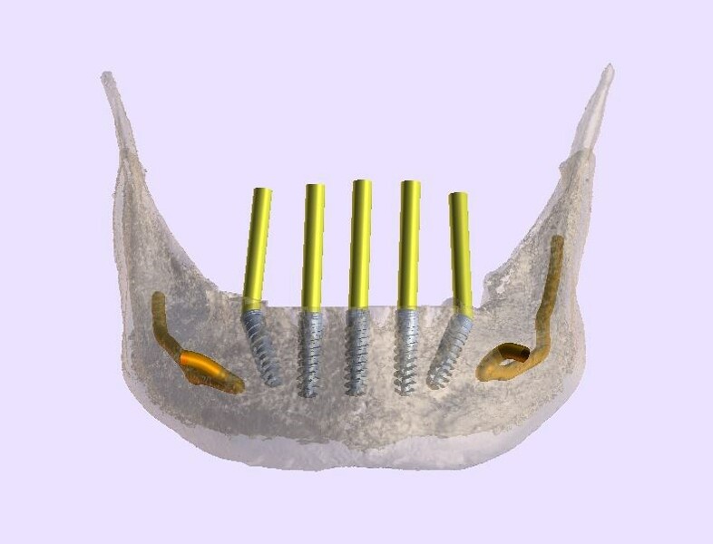 Fig. 8b: Transparent STL model and virtual teeth.