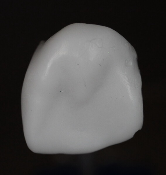Fig. 9: 3D-printed crown for tooth #11, lingual view.