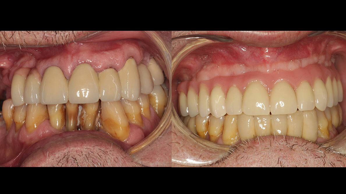 Tratamiento con all-on-four de paciente con dentición terminal