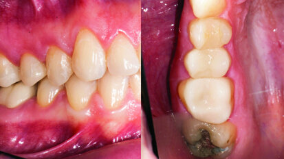 Une approche minimalement invasive respectueuse des principes biomécaniques des dents