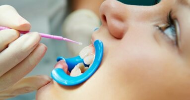 Relatório confirma eficácia dos selantes dentários contra cárie na infância