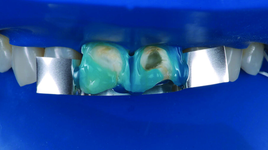 Tooth shade was determined with the aid of the VITA classical A1-D4® shade guide. The shade A1 matched the sound tooth structure. This corresponded with 3M™ Filtek™ Universal Restorative’s A1 shade.