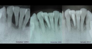 牙菌斑或可用于疾病的预测与治疗