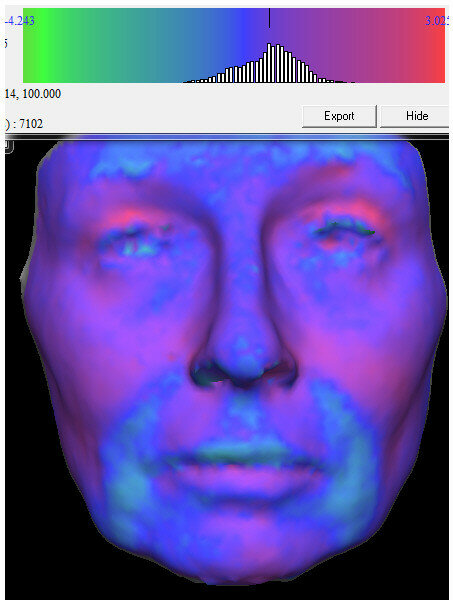 Fig. 5: Superimposing the red post-treatment face over the blue pretreatment face, we can graphically illustrate the volumetric
changes that occurred during our treatment. There was an increase in volume in the frontal, supra orbital, inferior orbital, zygomatic, nasal base, upper lip, nasolabial depression, and marionette and pre-jowl areas.