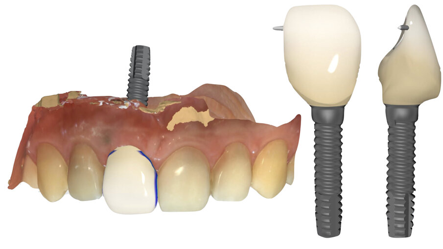 Fig. 32_Progettazione del dente protesico definitivo. La Maschera gengivale guida il software nella creazione del profilo d’emergenza del dente.