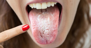 « Langue Covid » - les dentistes sont invités à rester attentifs aux symptômes de la cavité buccale