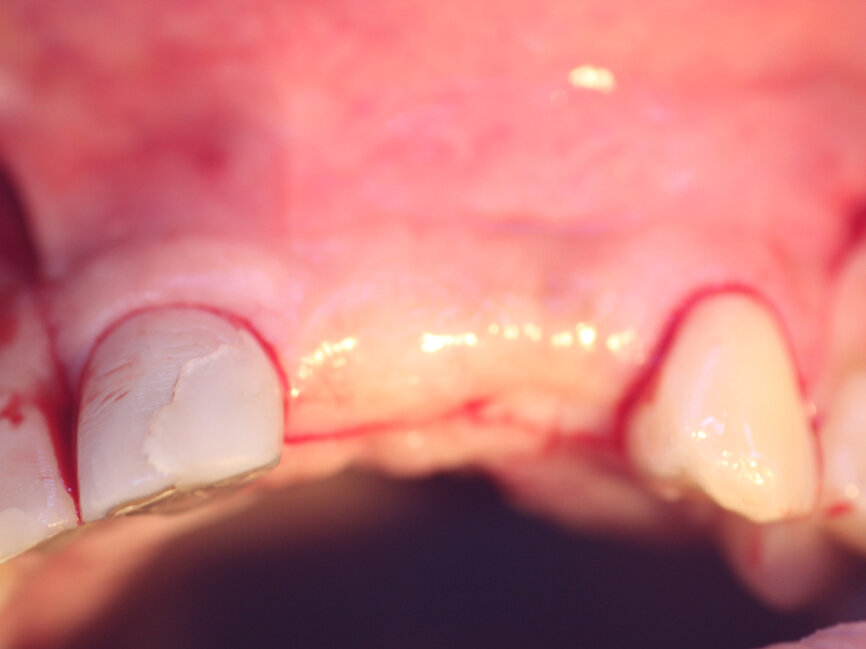 Fig. 15a: The previously deficient ridge at the left central and lateral incisors resulting from resorption following the previously extracted teeth had been augmented and is ready for implant placement following 4.5 months of graft healing.