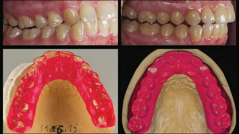 Figure 17: Brux Checker foil (left: initial situation; right: after the restorative treatment)