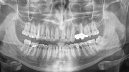 Endodontic treatment of maxillary left first molar with complicated root canal system