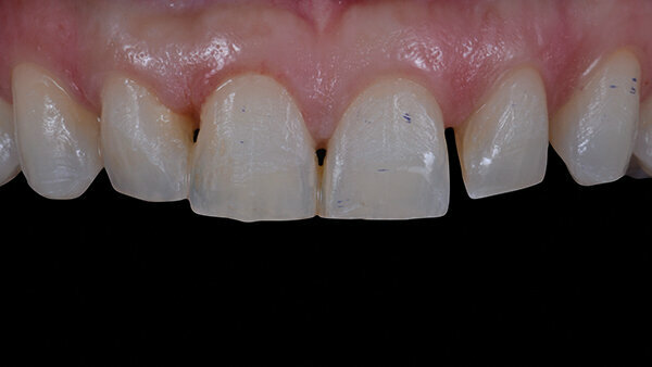 Fig. 7. Tejido periodontal de los dientes anteriores seis meses después del alargamiento coronario.