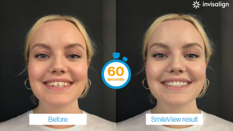 Invisalign Before and After: Kim's Journey With Clear Aligners