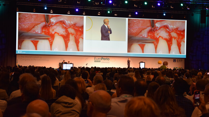On Thursday morning, Hall D was packed with attendees eagerly awaiting the livestreaming of two mucogingival surgeries that were to be performed to cover multiple gingival recessions.