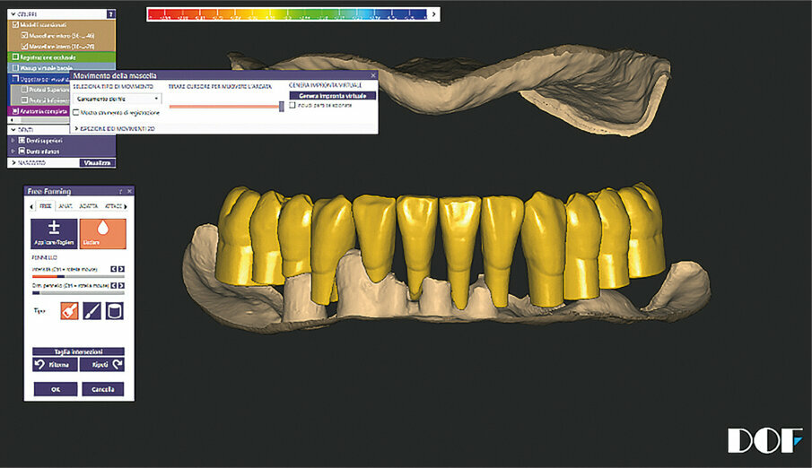 Fig. 10: Diagnostic tooth arrangement in the mandible.