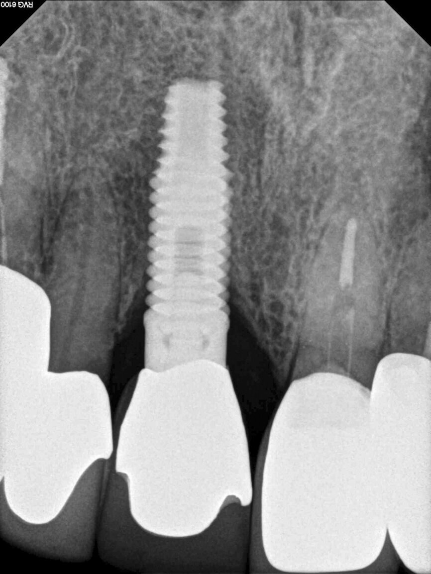 Fig. 13: The pre-op periapical radiograph revealed an existing implant-supported metal–ceramic restoration for the adjacent region #11.