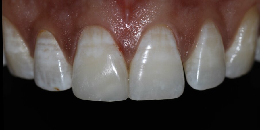 Fig 11: Tight proximal contact achieved. Final intraoral picture after finishing and polishing