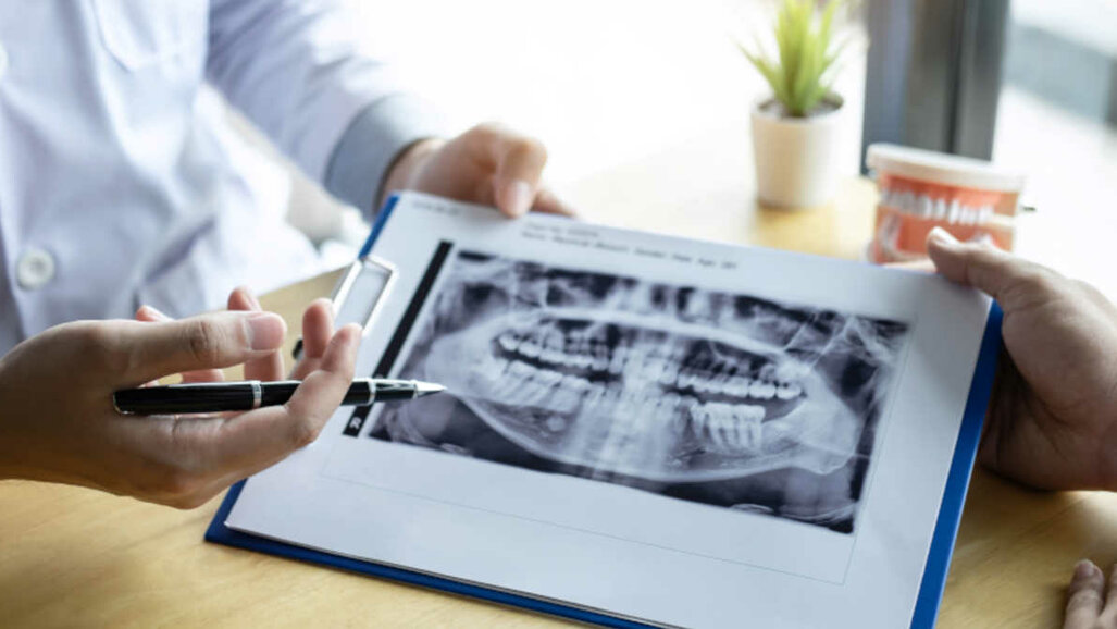 Nova pesquisa pode prevenir danos no maxilar de pacientes com câncer que precisam de cirurgia oral