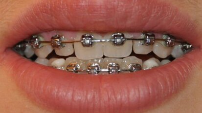 Raziskovalci  razvijajo nov izdelek dentalne nege, za oskrbo  ortodontskih pacientov