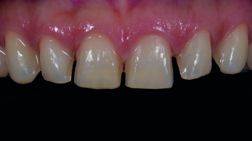 Fig. 9c : Préparation finale des dents.
