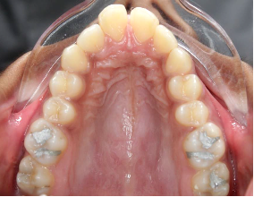 Fig 8a: Pretreatment intraoral view showing severe transverse and anteroposterior jaw discrepancy