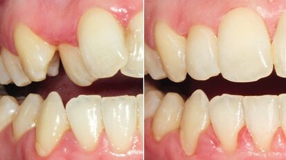 Durchsichtiges Spangensystem: In sechs Monaten zu geraden Zähnen