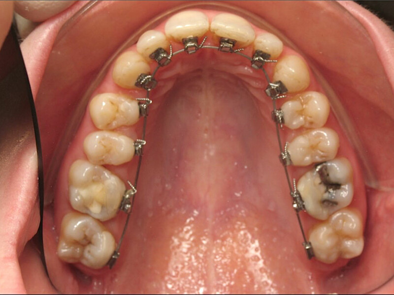 Figura 1. Paciente con tratamiento de ortodoncia lingual.