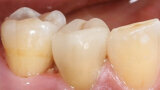 Fig. 12. Desde vestibular no se observaban transiciones entre la restauración y el diente.