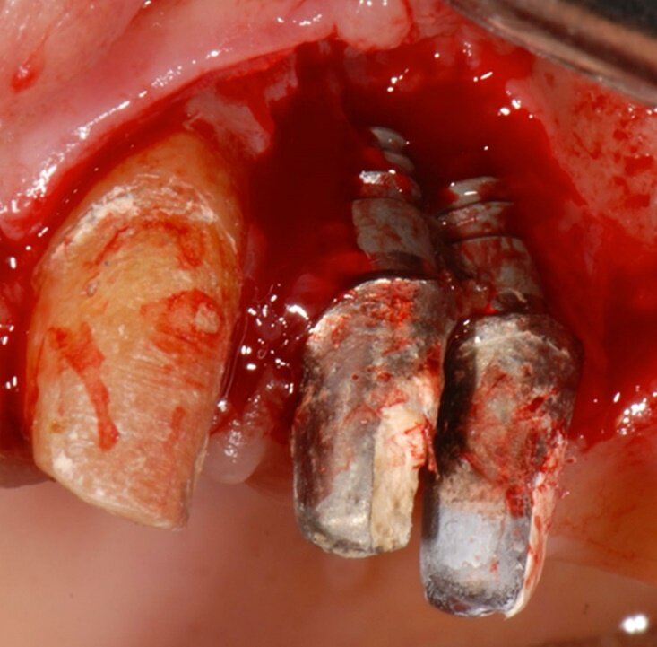 Fig. 2 - Aspetto dei due impianti alla chirurgia di rimozione implantare; si noti come il riassorbimento osseo giunge al livello apicale degli impianti.