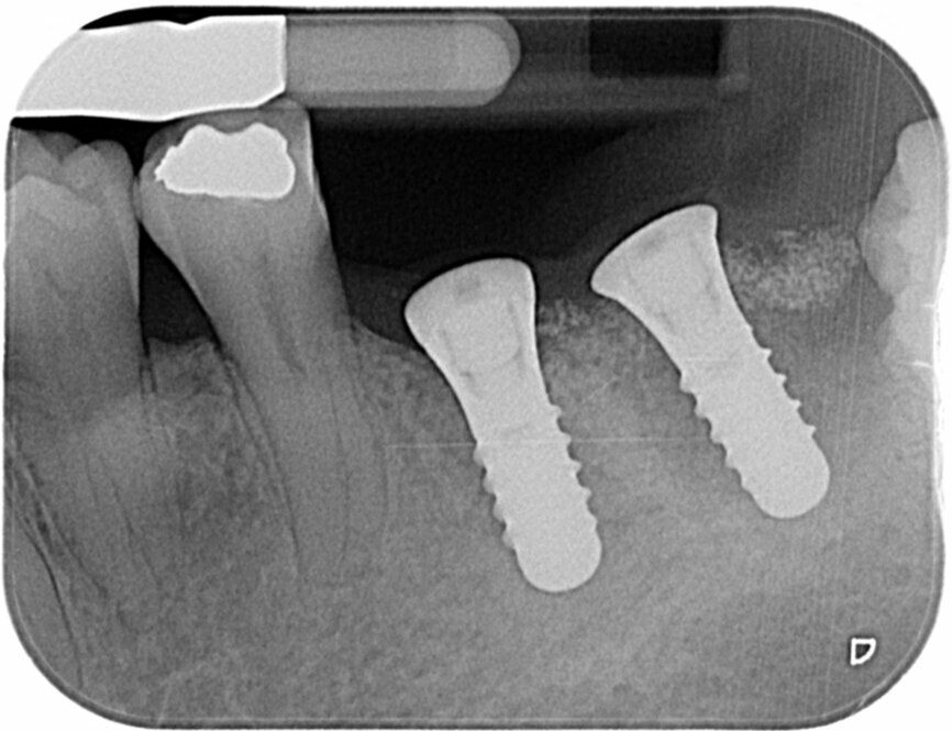 Fig. 8: Postoperative radiograph of implant placement.