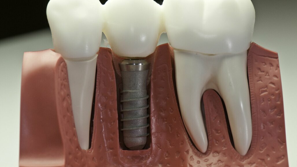bereik Lijkt op kwaadheid de vrije loop geven Sneller plaatsen van tandkroon op implantaat mogelijk