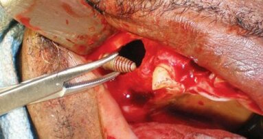 Implants migrés dans le sinus maxillaire