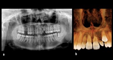 Abordaje mínimamente invasivo en ortodoncia