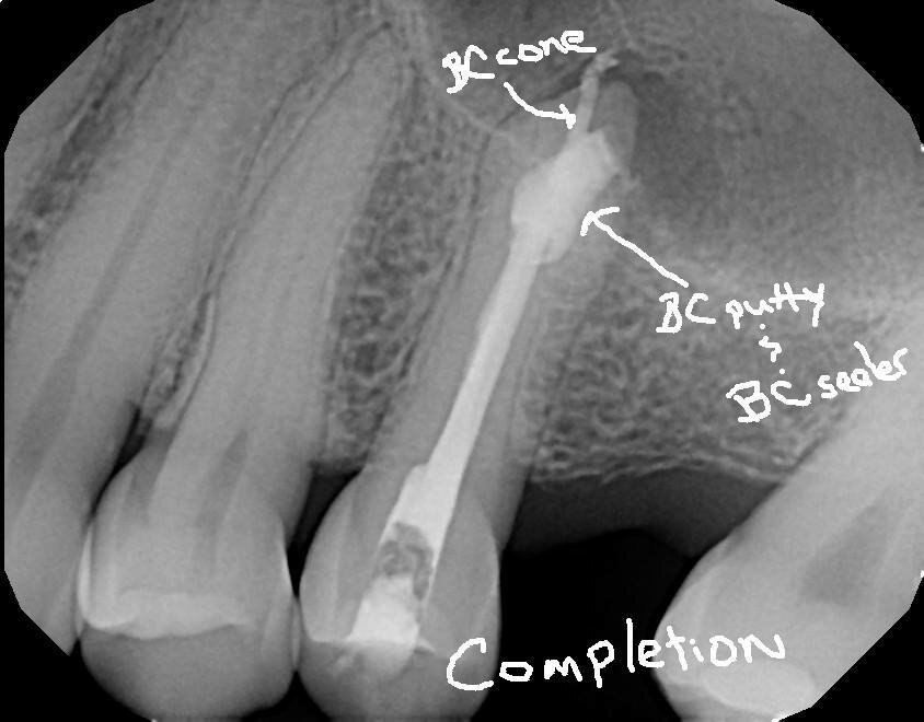 Fig. 16b: Case treated with a Bioceramic master cone, sealer and putty. Note the excellent apical control in this blunderbuss apex. (Courtesy of Dr. Rico Short)
