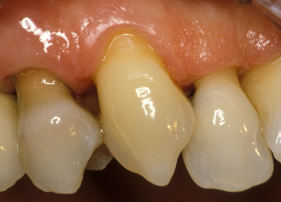 Fig. 2 - La recessione gengivale è la prima causa di esposizione dei tubuli dentinali che può causare ipersensibilità dentinale.