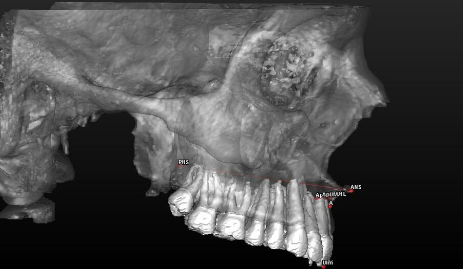Fig. 3_Ricostruzione 3D del mascellare superiore ed arcata dentaria con visione di profilo dei landmark utilizzati.