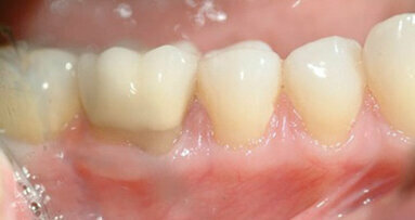 Novel approach to gingival grafting: Single-stage augmentation graft for root coverage