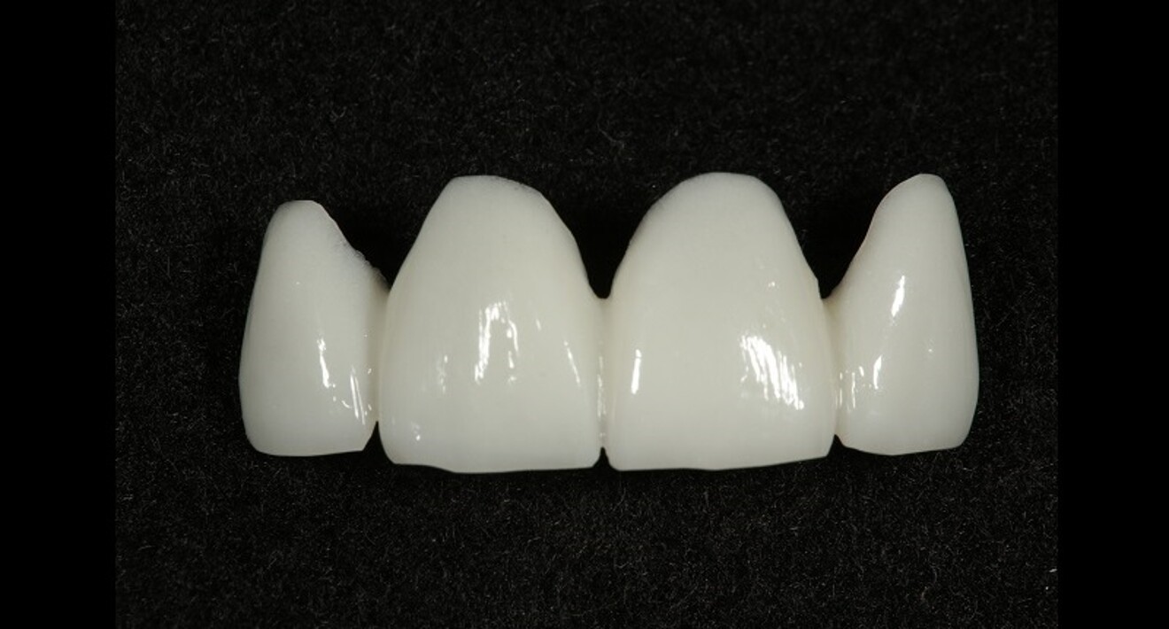 Fig. 12: Second PMMA prototype for teeth #12–22. A slightly angular modication of the first prototype gave a more squared-off appearance to the incisal embrasures and angles. Minor irregularities on the incisal edges also added to a more characterised look.